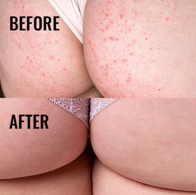 Bum acne